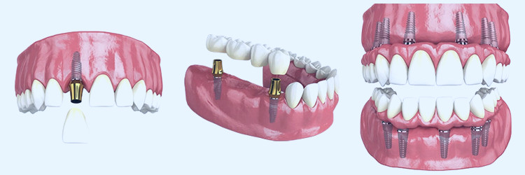 Hybridge Dental Implants | Brown & Nawrocki Restorative & Cosmetic Dentistry  | Ormond Beach Tooth Replacement